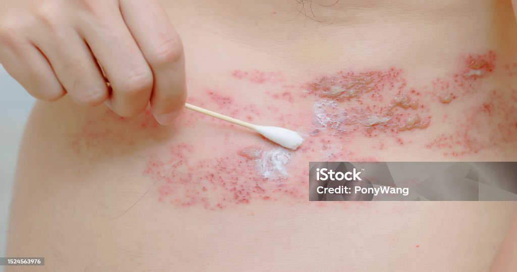 man apply the ointment close up asian male patient is applying the ointment to himself about his shingles disease on skin Allergy Stock Photo