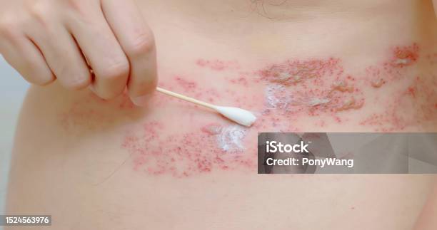 Man Apply The Ointment Stock Photo - Download Image Now - Allergy, Rash - Skin Condition, Adult