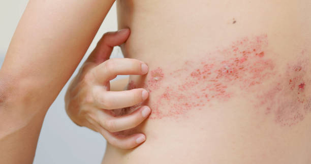 man has shingles disease close up asian male patient has shingles disease on skin and feel pain shingles rash stock pictures, royalty-free photos & images