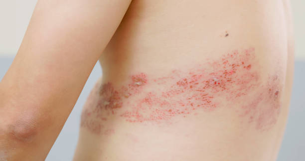 man has shingles disease close up affected site of asian male patient has shingles disease on skin and feel pain shingles rash stock pictures, royalty-free photos & images