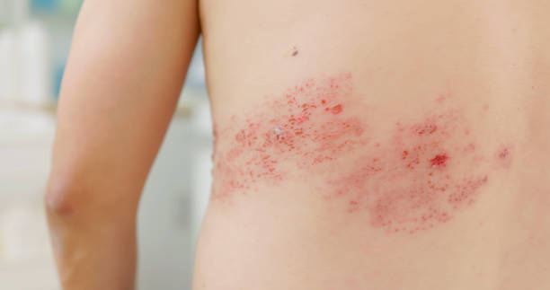 man has shingles disease close up affected site of asian male patient has shingles disease on skin and feel pain shingles rash stock pictures, royalty-free photos & images