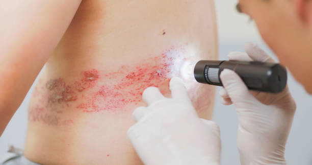 istock doctor examine shingles disease 1524570714
