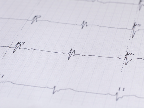 Cardiogram Chart (ECG). Close-up. Hospital.