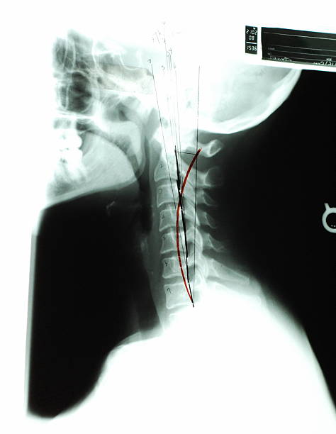 neck x-ray stock photo