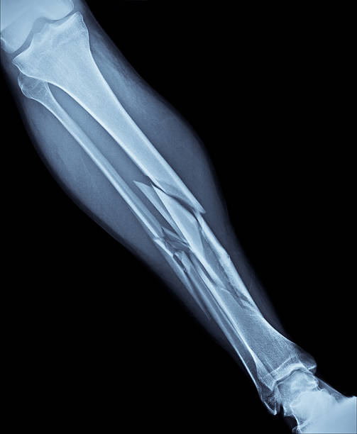 Broken Leg X-Ray An x-ray of my shattered right leg showing multiple fractures of both the tibia and fibula.  This injury was the result of a skiing accident and oh man did it hurt. tibia photos stock pictures, royalty-free photos & images