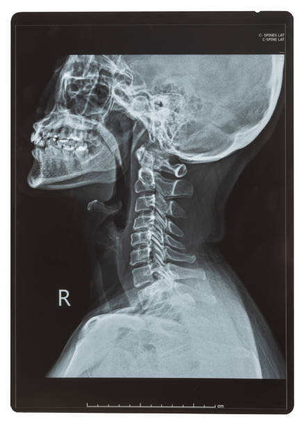 radiographie de la colonne vertébrale c ou image de la colonne cervicale vues latérales de la patiente pour le diagnostic médical sur la hernie discale intervertébrale ou la radiculopathie cervicale, la spondylose et la fracture - radiogram photographic image photos et images de collection