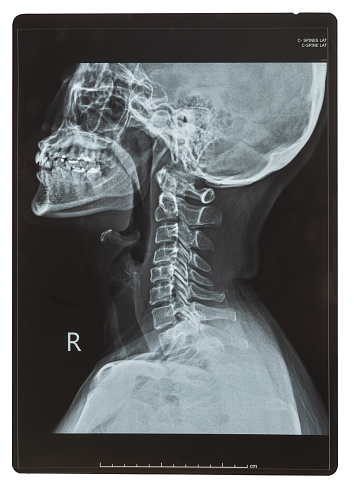 C-spine x-ray or Cervical spine image lateral views of female patient for doctor diagnosis on intervertebral disc herniation or Cervical radiculopathy, Spondylosis and fracture