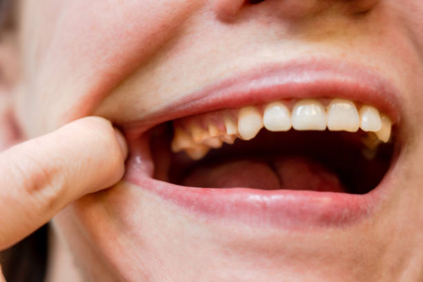 istock Woman's teeth before prosthetics. Full mouth 1526742837