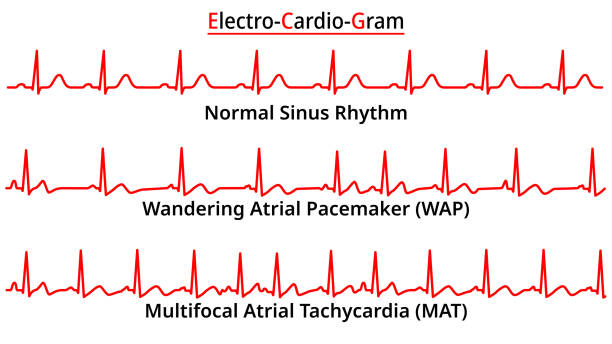 Wanding Example 1,100+ Tachycardia Stock Illustrations, Royalty-Free Vector Graphics ...