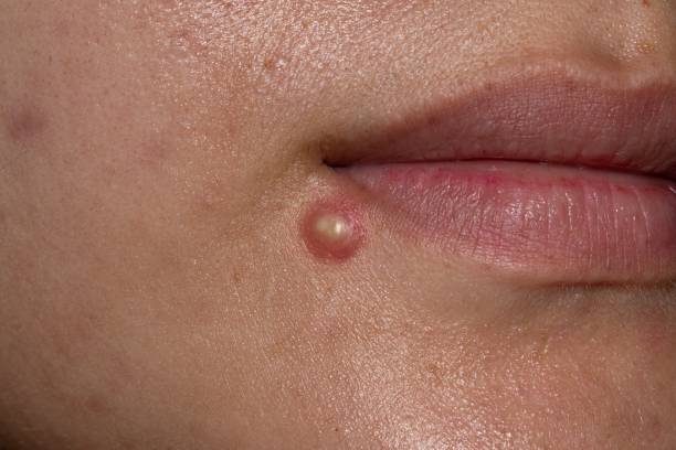 istock Cystic acne becoming abscess on the face. Large pustule. 1527211375