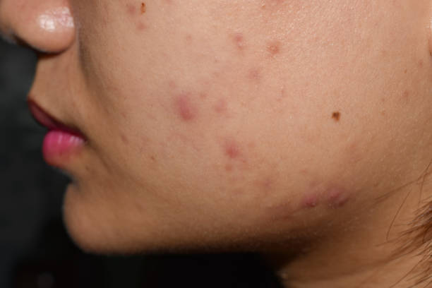 istock Acne, black spots and scars oily on face 1528526948