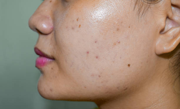 istock Chloasma or melasma , black spots and acne scars 1528527979