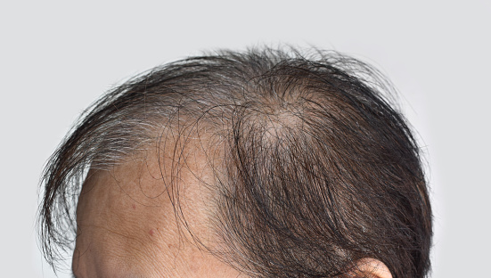 Thinning or sparse hair, male pattern hair loss in Southeast Asian, Chinese elder man.