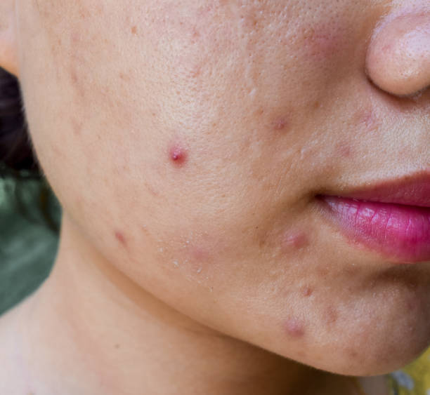 istock Acne , black spots and scars oily on face 1528534232