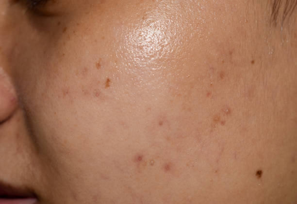istock Chloasma or melasma , black spots and acne scars 1528534233