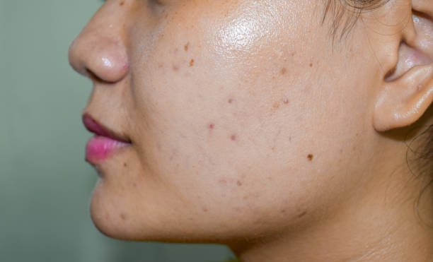 istock Chloasma or melasma , black spots and acne scars 1528534238