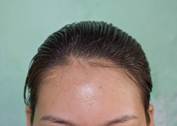 Oily skin and pimples on wide forehead of Asian adult young woman. Oily skin and pimples on wide forehead of Southeast Asian, Myanmar or Korean adult young woman. woman hairline stock pictures, royalty-free photos & images