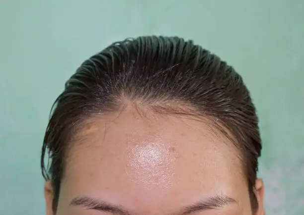 Photo of Oily skin and pimples on wide forehead of Asian adult young woman.