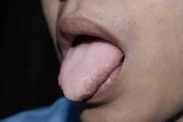 Coated tongue or white tongue of Asian, Chinese man. It appears with white layer when debris, bacteria and dead cells become lodged between enlarged papillae. Loss of taste called ageusia.