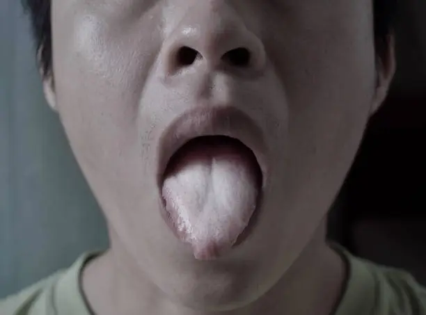 Coated tongue or white tongue of Asian, Chinese man. It appears with white layer when debris, bacteria and dead cells become lodged between enlarged papillae. Loss of taste called ageusia.
