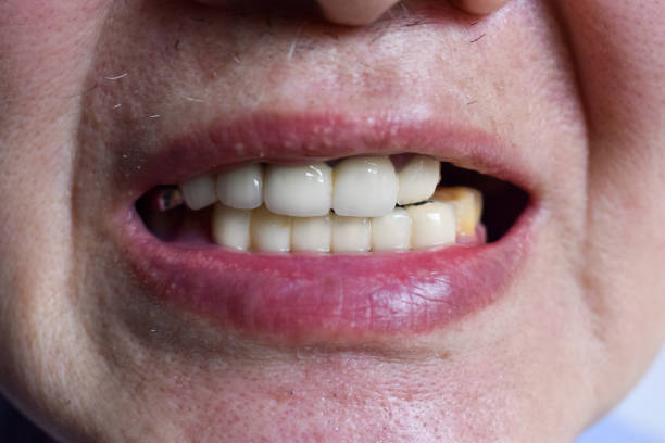 Zirconia Crowns of Front Teeth in Asian Old Man