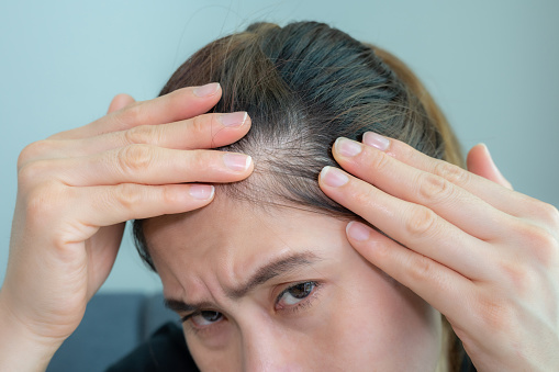 Female pattern hair loss can progress from a widening part to overall thinning.
