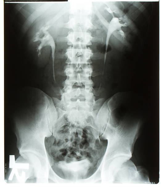 istock X-Ray of a male body with kidneys 152955310