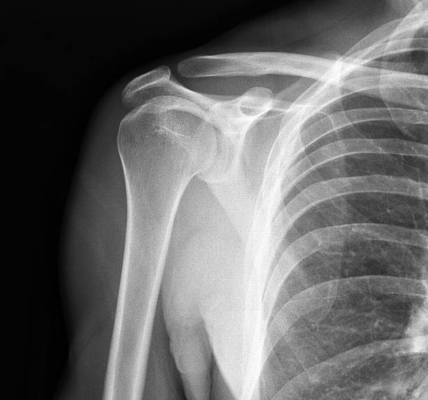 x-ray d'articulation de l'épaule - x ray x ray image shoulder human arm photos et images de collection