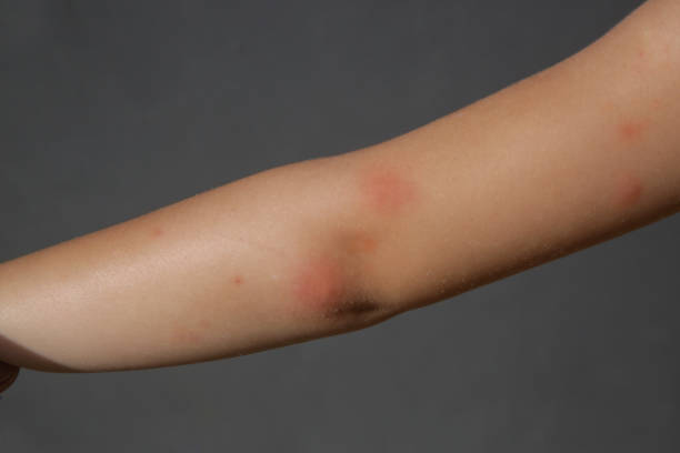 little girl has skin rash from allergy or mosquito bites - mosquito child bug bite scratching imagens e fotografias de stock