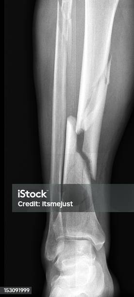 Сломанная Нога — стоковые фотографии и другие картинки Рентгеновский снимок - Рентгеновский снимок, Сломанная нога, Голень