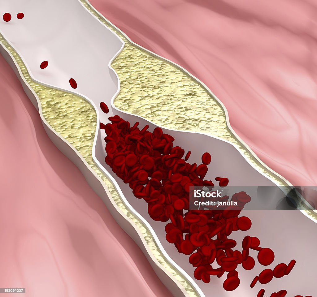 Athérosclérose maladie-obstrué artères (Arterial Plaque) - Photo de Bouché libre de droits