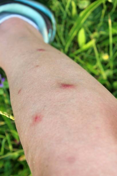 istock A woman's leg with inflamed mosquito bites. She got the bites while on holiday. 1531174456