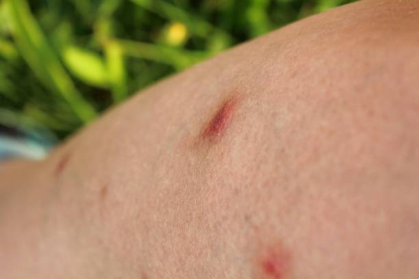 istock A woman's leg with inflamed mosquito bites. She got the bites while on holiday. 1531174465