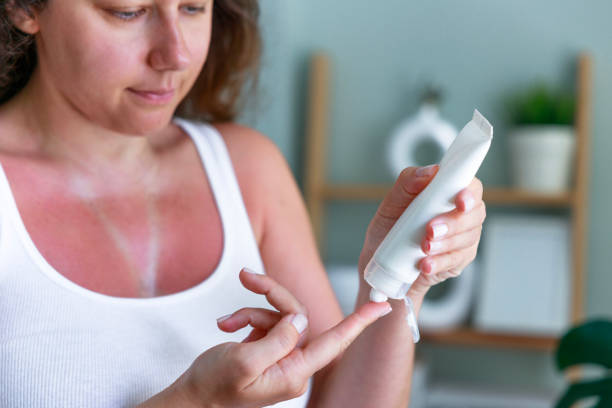 istock Young woman applying moisturizer on sunburned skin 1531218109