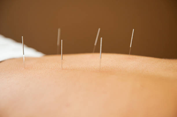 acupuncture stock photo