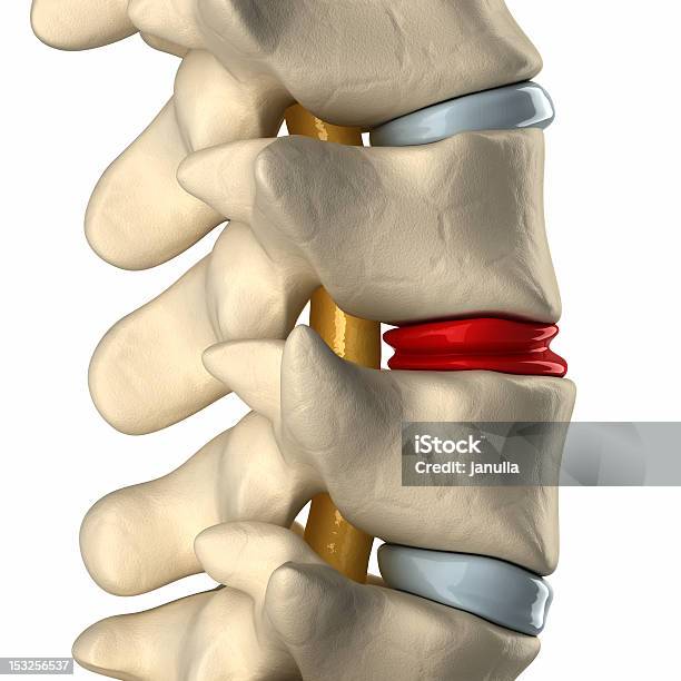Degenerated ディスクの脊椎 - 椎間板のストックフォトや画像を多数ご用意 - 椎間板, ダメージ, 人体構造