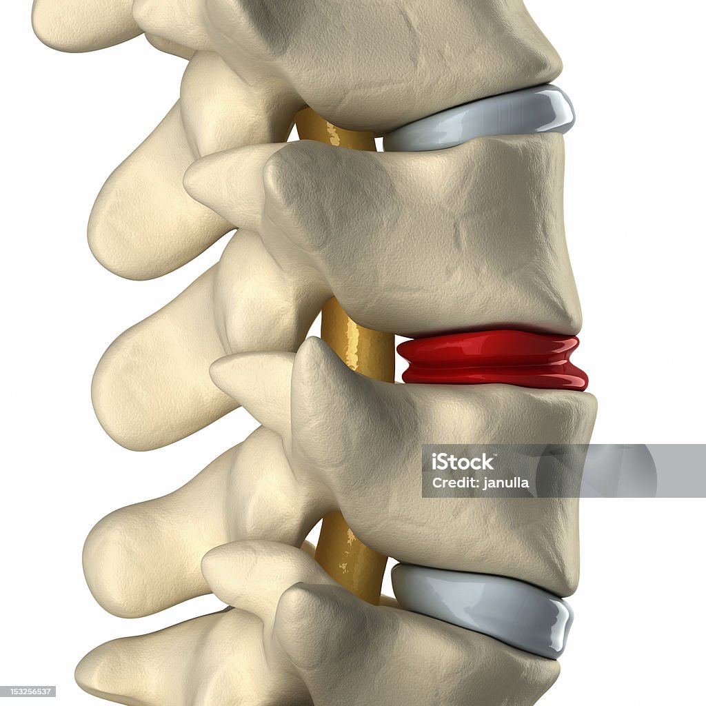 Дегенера�ции диска в позвоночник - Стоковые фото Межпозвоночный диск роялти-фри