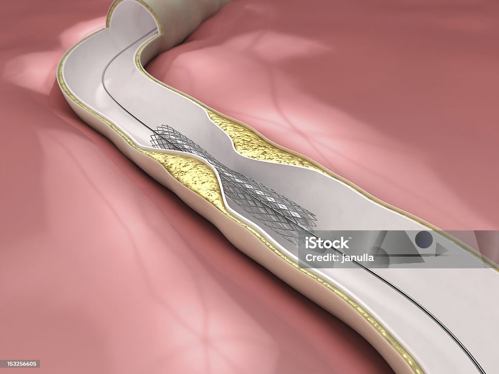 Coronary Angioplasty procedure Stent in vein in 3D Anatomy Stock Photo