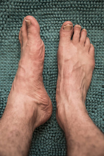 istock Psoriasis in the foot in a very serious condition. 1533085914