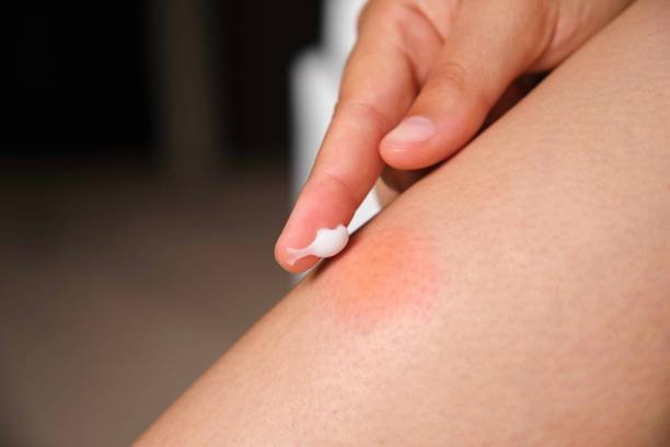 Woman applying medicine cream on mosquito bite on her leg. Woman applying medicine cream on mosquito bite on her leg. Allergic reaction, itch, irritation due to insect bite concepts. red wasp stock pictures, royalty-free photos & images