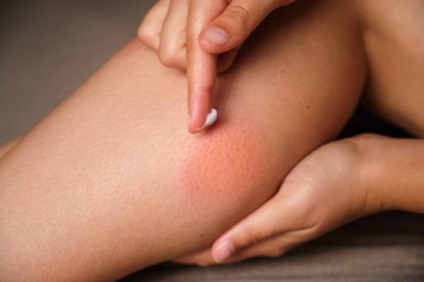 Woman applying medicine cream on mosquito bite on her leg. Woman applying medicine cream on mosquito bite on her leg. Allergic reaction, itch, irritation due to insect bite concepts. red wasp stock pictures, royalty-free photos & images