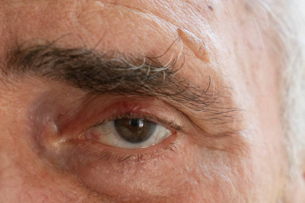 istock Red irritated male eyes 1533276457