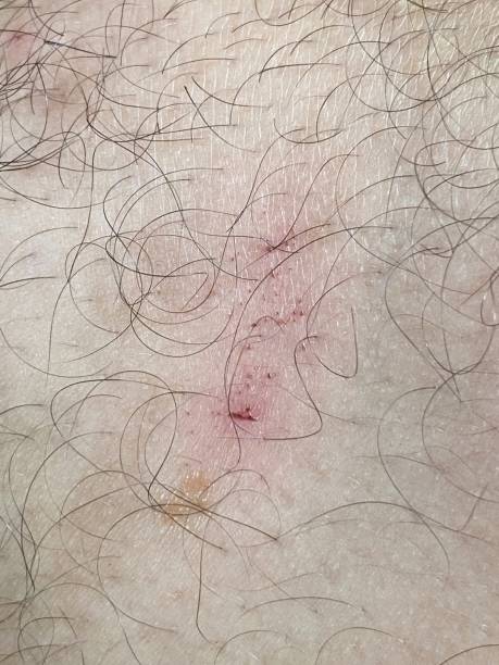 istock scar on skin 1533400316