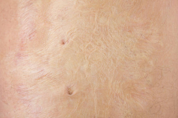 istock Burn scars, burn scars on the body. Consequences of burns. 1533621127