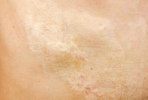 istock Burn scars, burn scars on the body. Consequences of burns. 1533621177