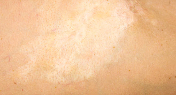 istock Burn scars, burn scars on the body. Consequences of burns. 1533621716