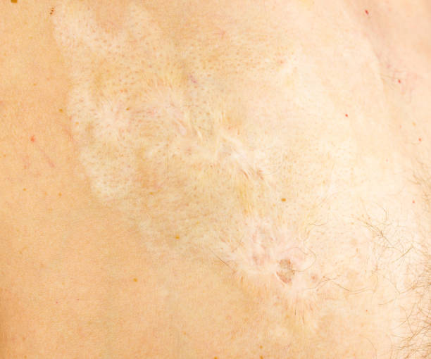 istock Burn scars, burn scars on the body. Consequences of burns. 1533621756