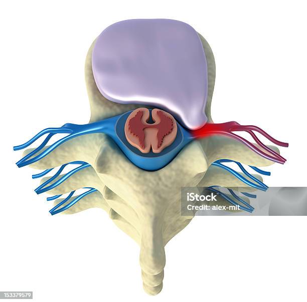 Prolapse Intervertebral のディスク - 真俯瞰のストックフォトや画像を多数ご用意 - 真俯瞰, 3D, X線撮影