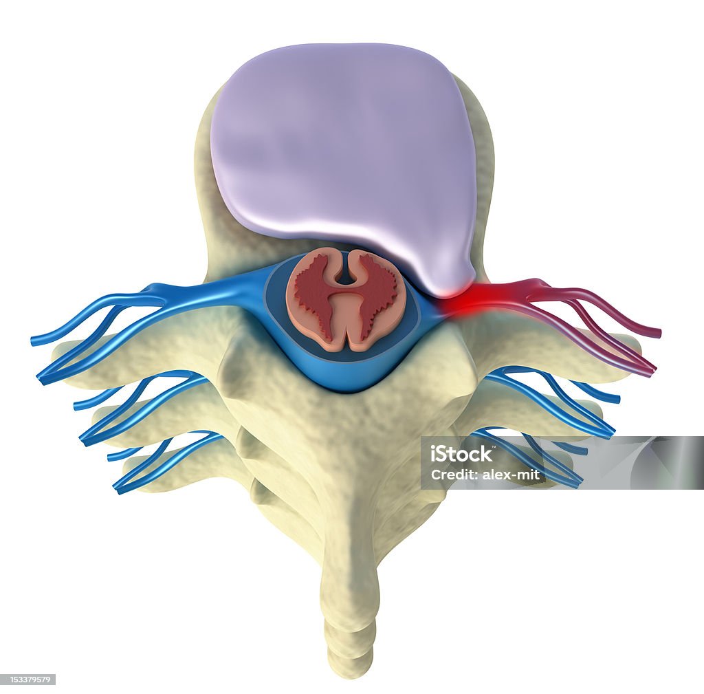 Пролапс межпозвоночного диска из - Стоковые фото Прямо над роялти-фри