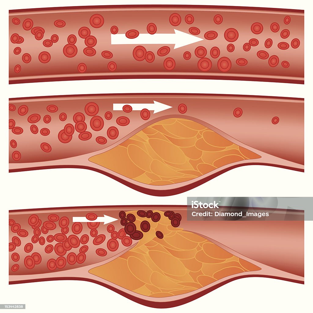 アテローム性動脈硬化 - アテローム性動脈硬化のロイヤリティフリーベクトルアート